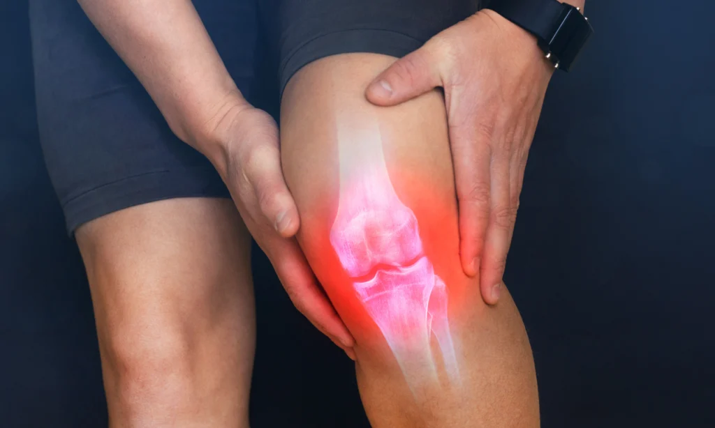 Signes d’une rupture du ligament croisé anterieur (LCA)