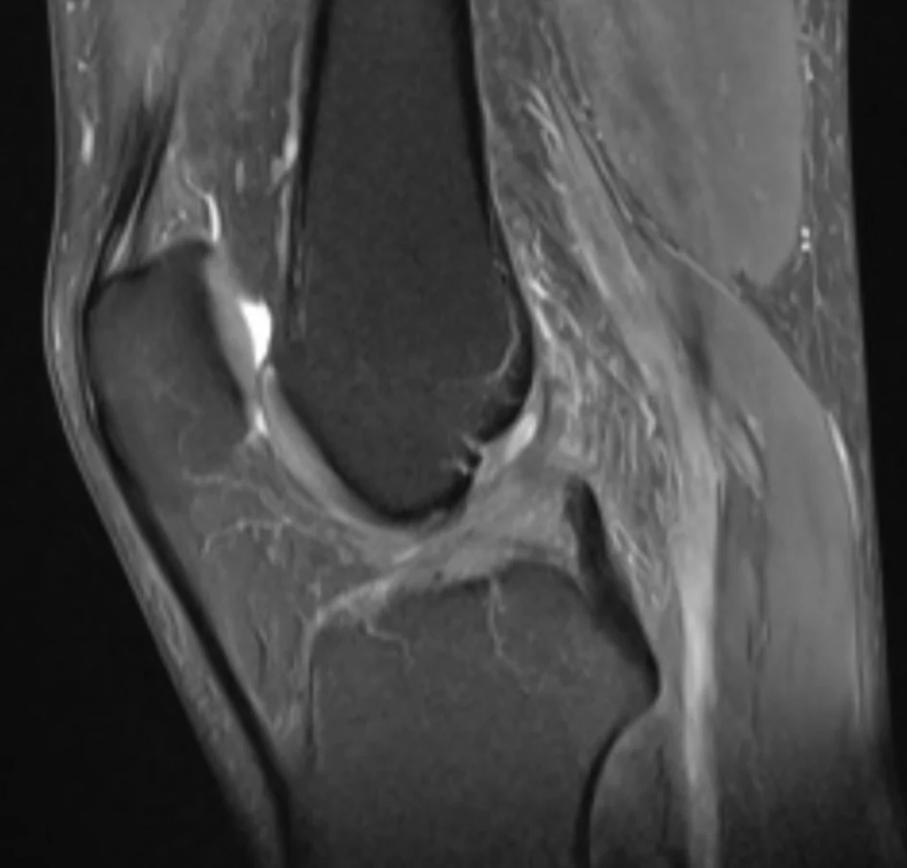 Ligament croisé antérieur