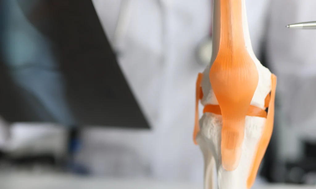 ligament crois anterieur x ligament crois anterieur x Ligament croisé antérieur Dr Pierre SAUTET - Chirurgien orthopédiste Seine-Saint-Denis