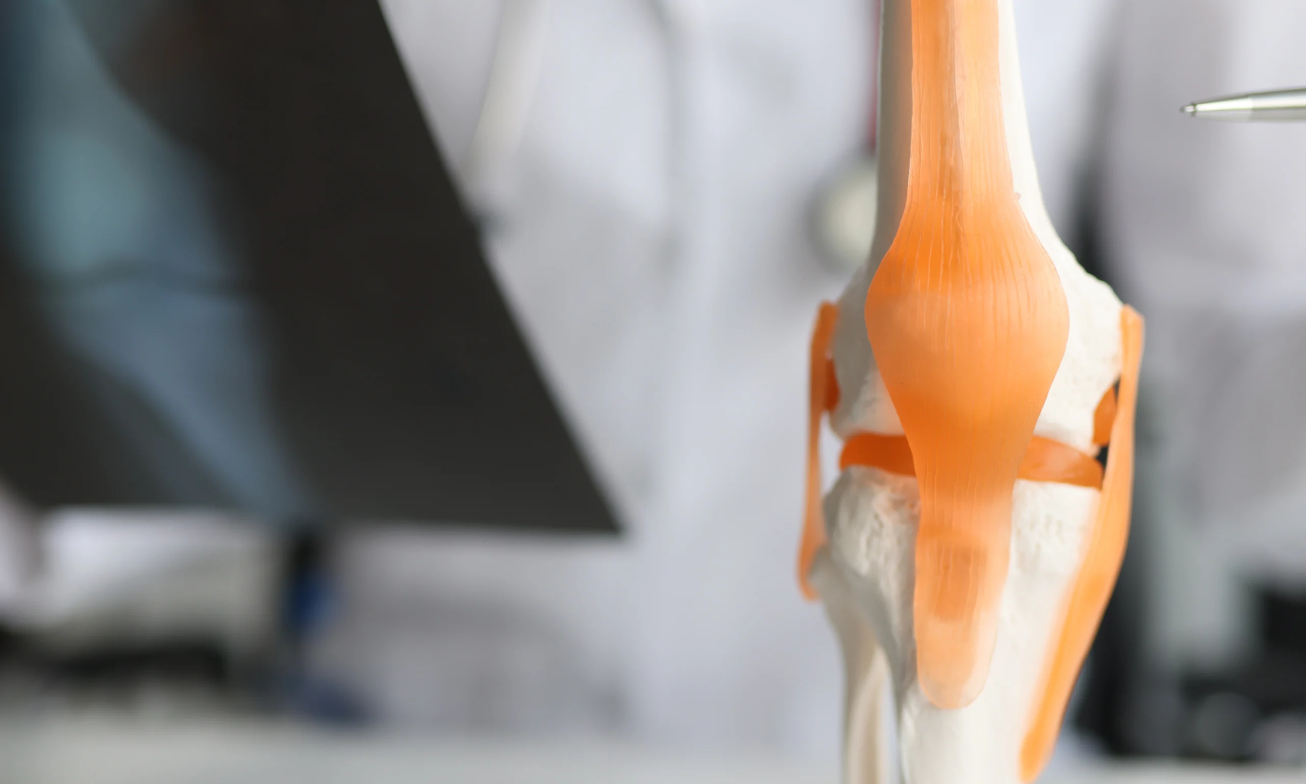 ligament crois anterieur Ligament croisé antérieur Dr Pierre SAUTET - Chirurgien orthopédiste Seine-Saint-Denis