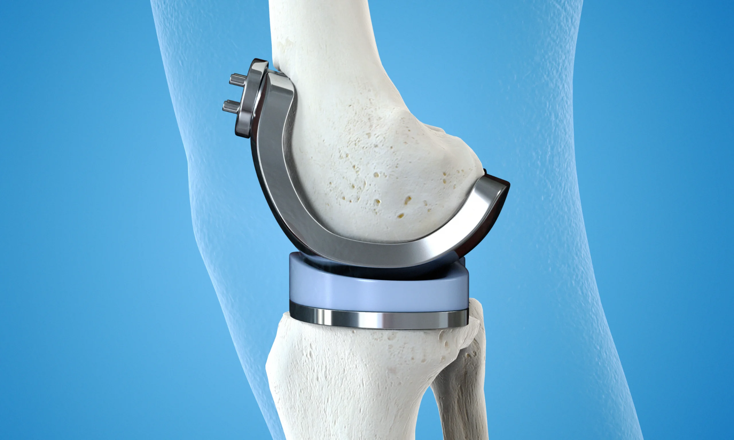 prothese totale genou orthopediste scaled prothese totale genou orthopediste scaled Traitements du genou Dr Pierre SAUTET - Chirurgien orthopédiste Seine-Saint-Denis